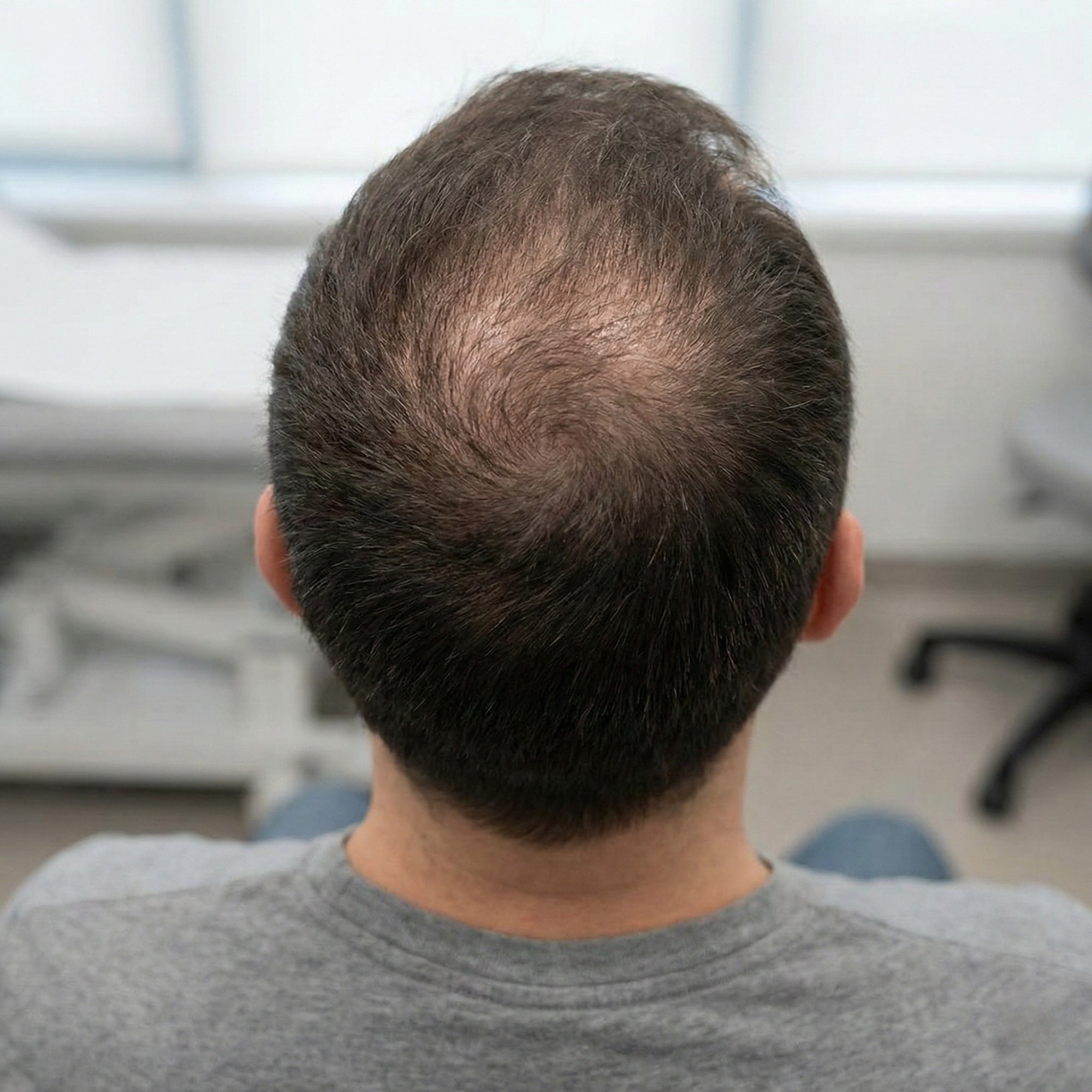 Mann mit allmählicher Haarverdünnung am Oberkopf