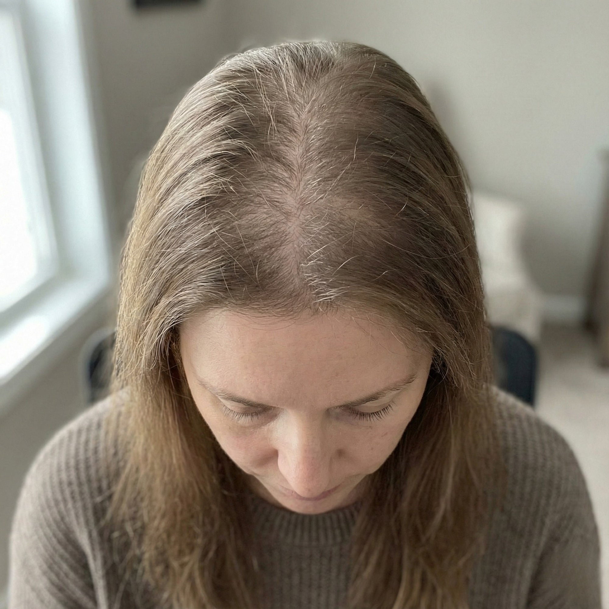 Diffuser Haarausfall bei Frauen